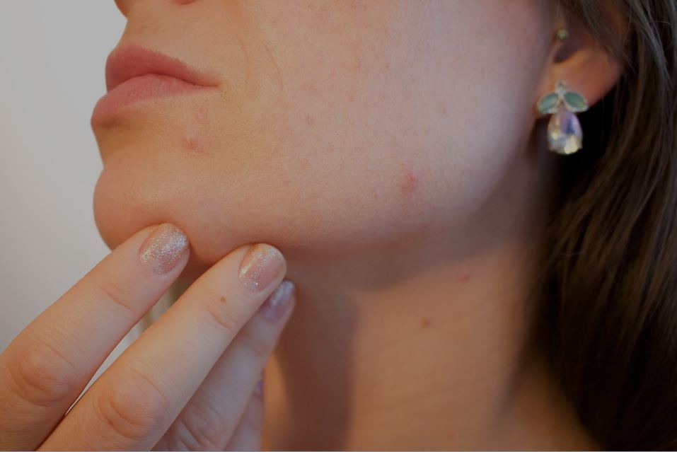 The major concern of Acne