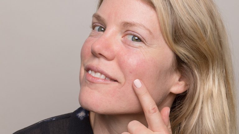 Acne the What, Why and How?